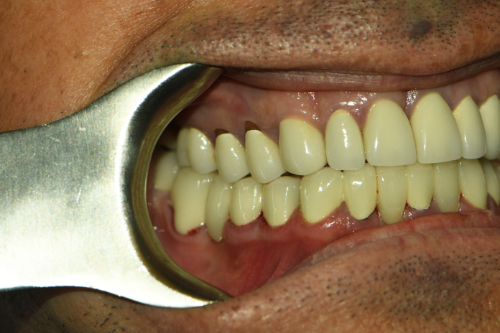 Great Neck Dental Arts | LANAP reg  Laser, Ceramic Crowns and Invisalign reg 