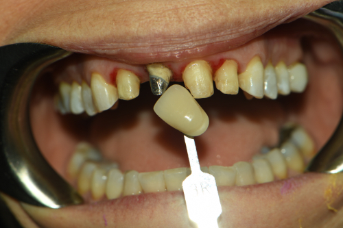 Great Neck Dental Arts | Ceramic Crowns, Dental Bridges and Sports Mouthguards