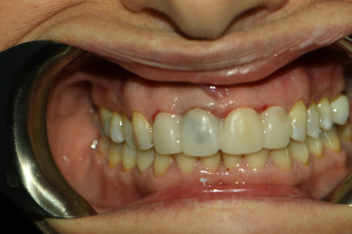Great Neck Dental Arts | Dental Fillings, Night Guards and Veneers