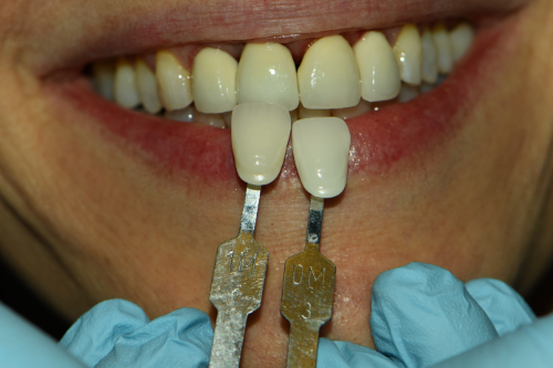 Great Neck Dental Arts | LANAP&reg; Laser, Ceramic Crowns and Invisalign&reg;
