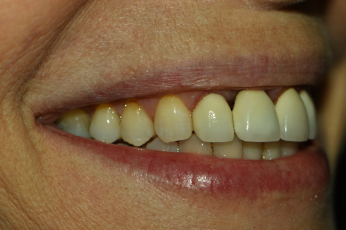 Great Neck Dental Arts | LANAP&reg; Laser, Teeth Whitening and Implant Dentistry