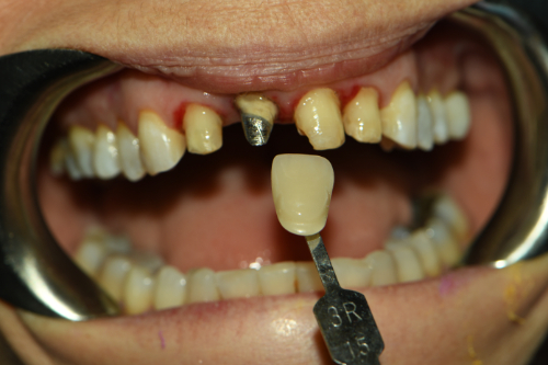 Great Neck Dental Arts | LANAP reg  Laser, Invisalign reg  and Preventative Program