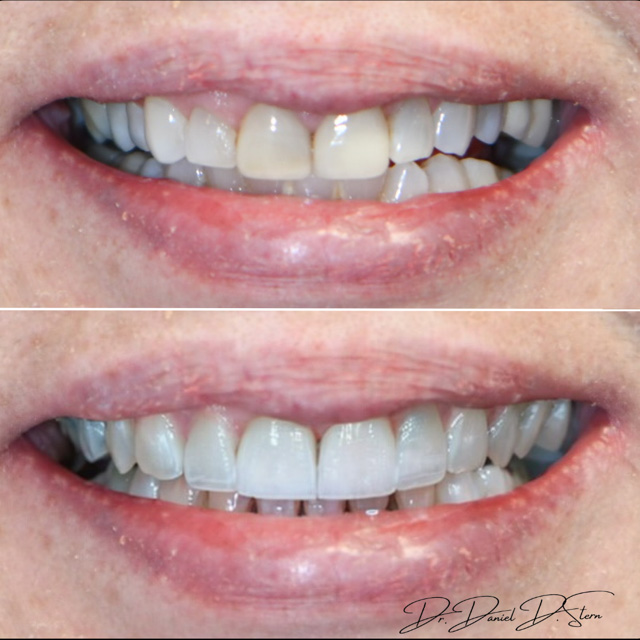 Great Neck Dental Arts | LANAP reg Laser, Ceramic Crowns and Invisalign reg